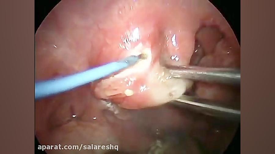 جراحی فوق پیشرفته لوزه و یک عمل کامل