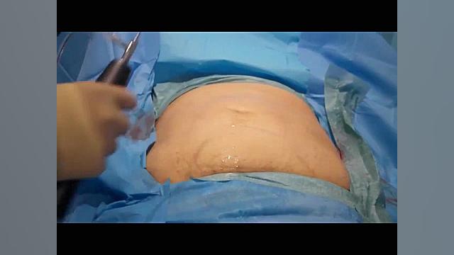 جراحی لیپوماتیک یا پیکر تراشی - تخلیه چربی شکم