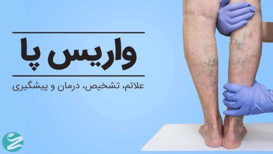 درمان واریس پا در طب سنتی