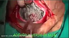فیلم عمل زایمان سزارین