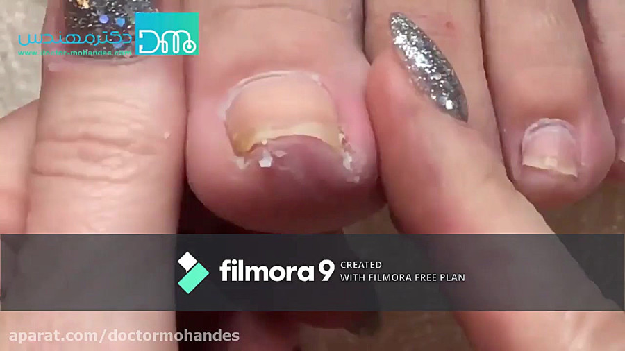 درمان خانگی فرو رفتن ناخن پا در گوشت