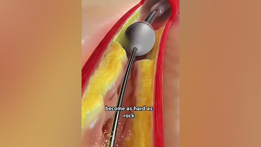 تکنولوژی جدید درمان گرفتگی عروق قلب